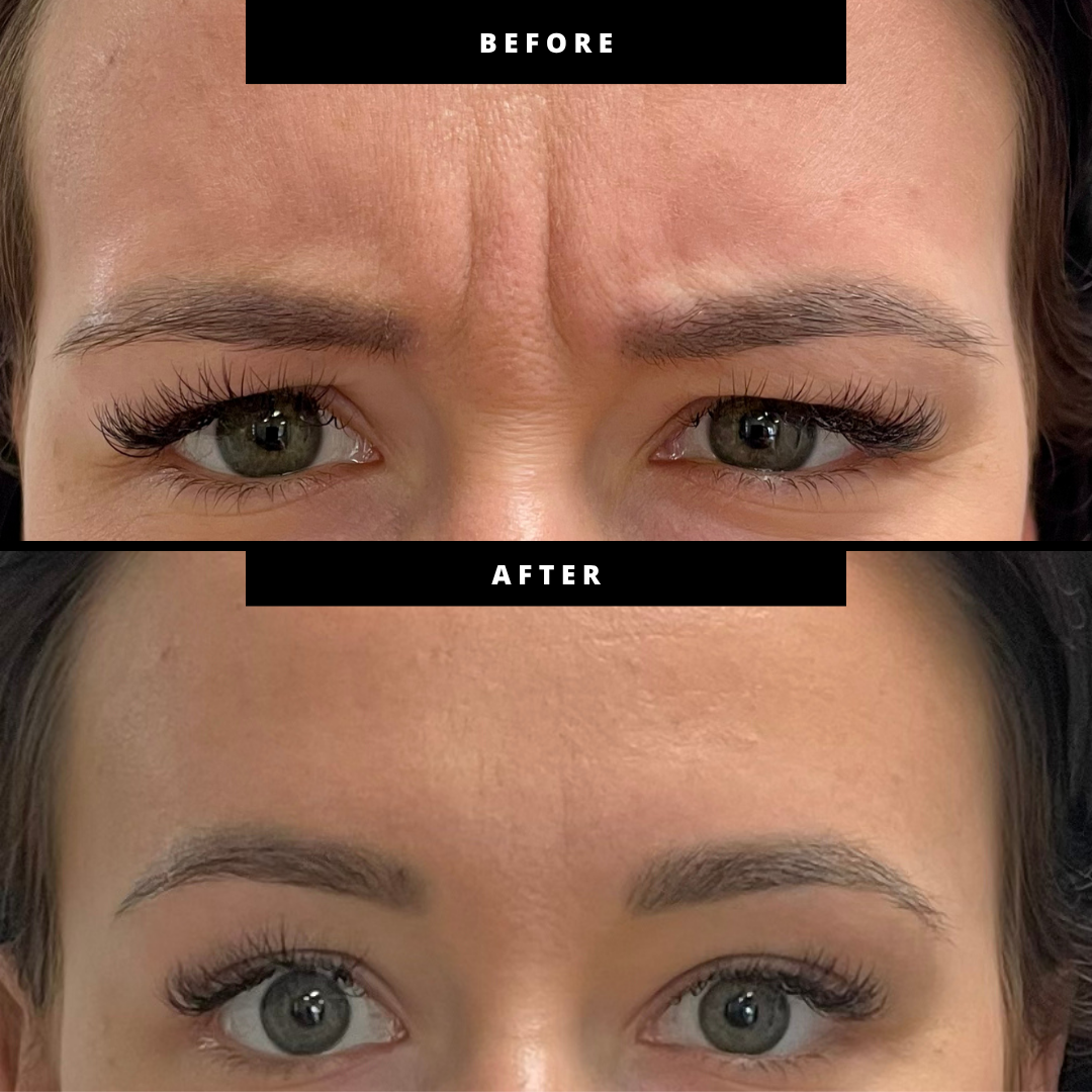Before and after neurotoxin treatment showing a smoother forehead and lifted brow area