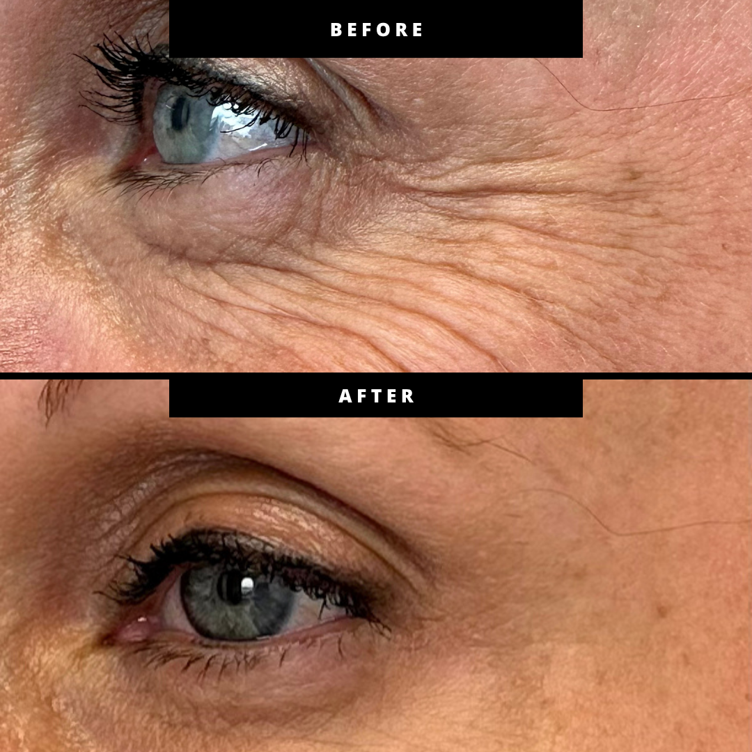 Before and after neurotoxin treatment showing smoother crow's feet around the eye